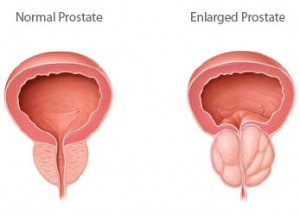 10 things you must know about this common health issue for men over 60